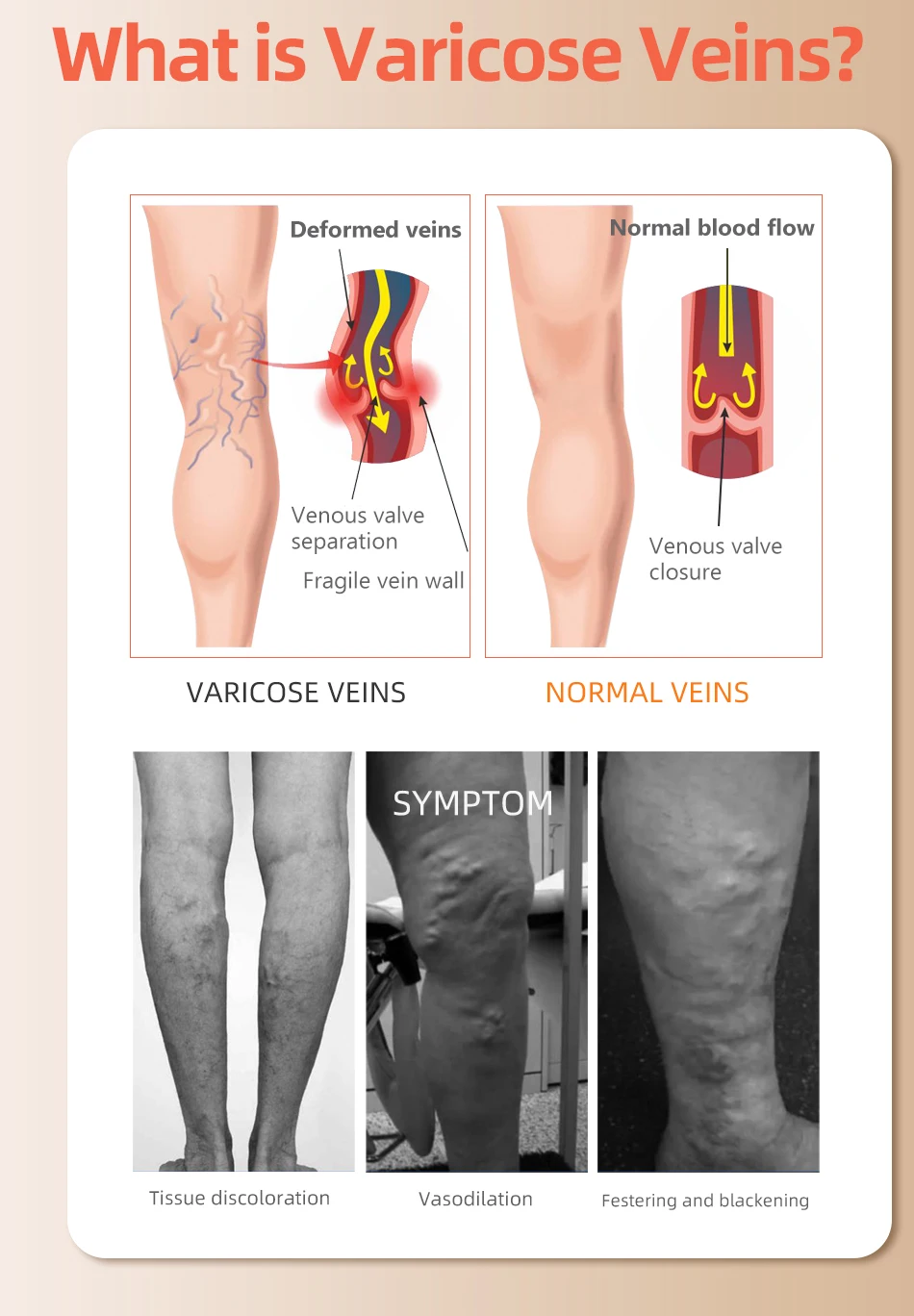 30-40 MmHg Over de Knie Geslot - Echinacea recensie en prijs